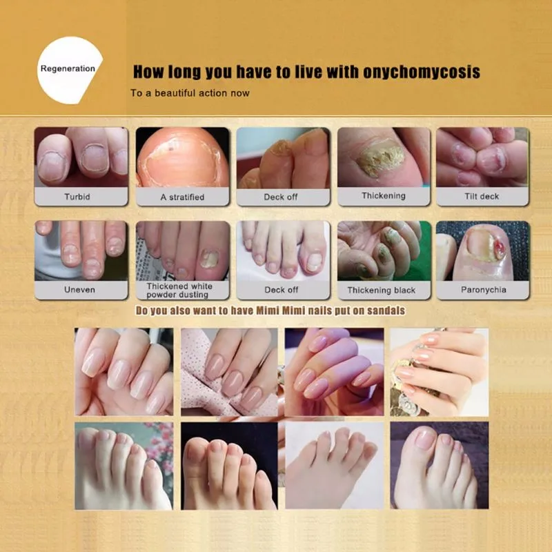 Лечение ногтей от грибка Уход за ногами эссенция для ногтей и отбеливание ног удаление грибка ногтей гель для ногтей