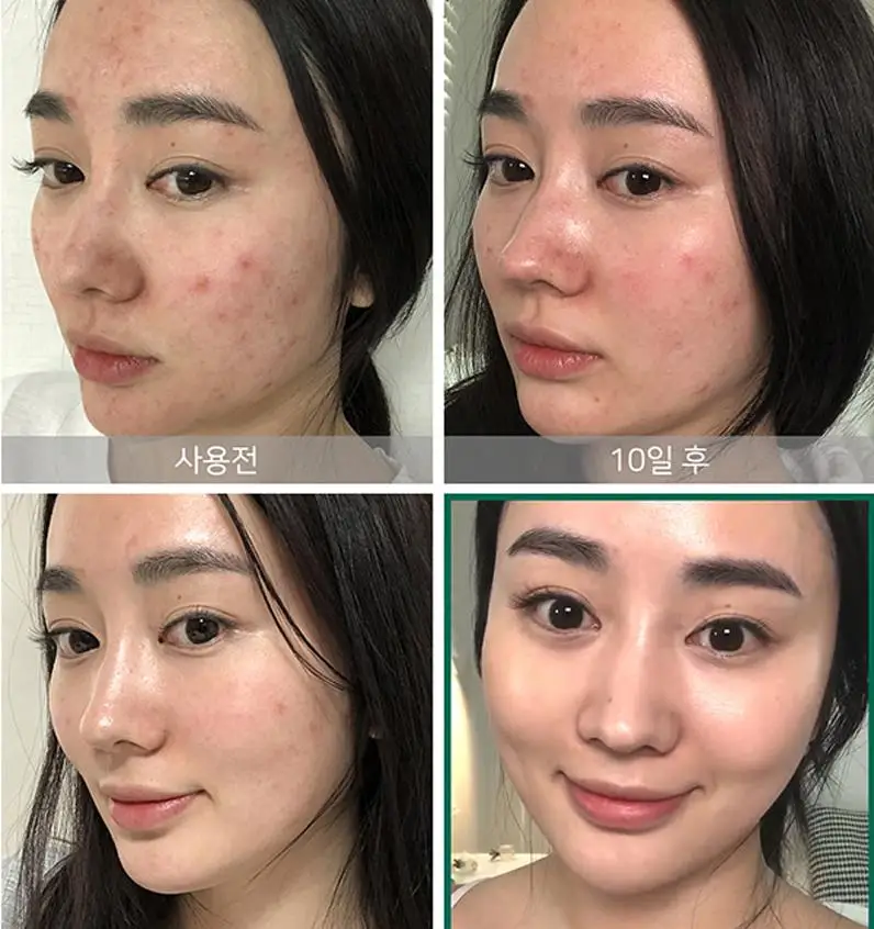Некоторые MI ана BHA ПГА 30 дней чудо крем уход за кожей лица отбеливает отпечаток