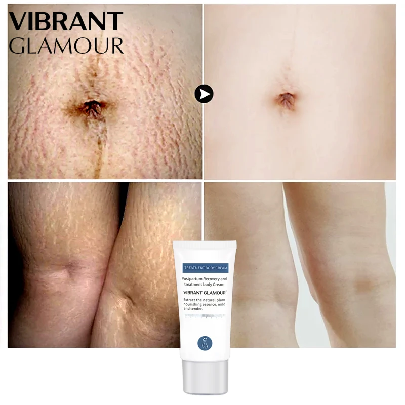 

VIBRANT GLAMOUR Crocodile Stretch Marks Remover Pregnancy Scars Ance Cream Maternity Repair Anti Aging Winkles Firming Body Care