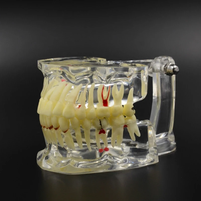 Good Quality Dental Implant Disease Tooth Pathological Extrusion Missing With impacted tooth dental pathological teeth implant dental implant biomaterials