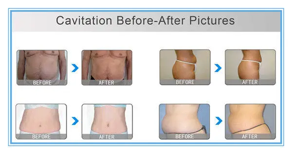 Skin Tightening Ultrasonic Cavitation Radio Frequency Slimming Machine