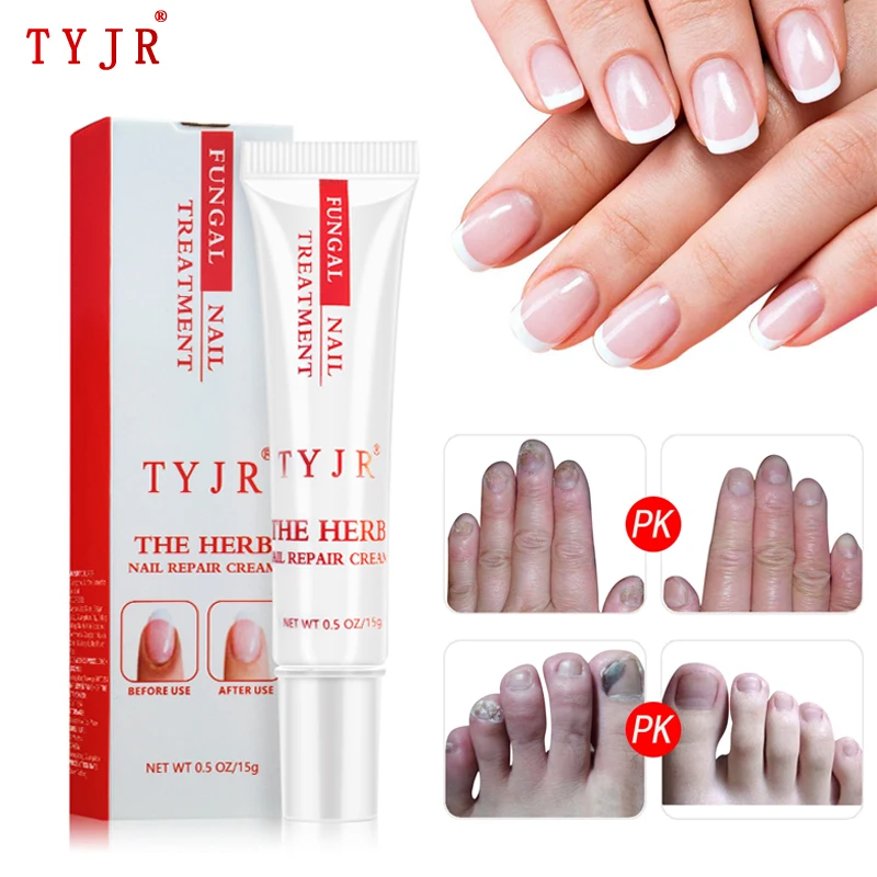 

Fungal Nail Repair Cream Herbal Nail Fungus Curve Treatment Anti Bacteria Onychomycosis Paronychia Anti Fungal Toenail Care
