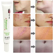 30 г крем для удаления шрамов крем пятна лечение удаление лица Уход за кожей