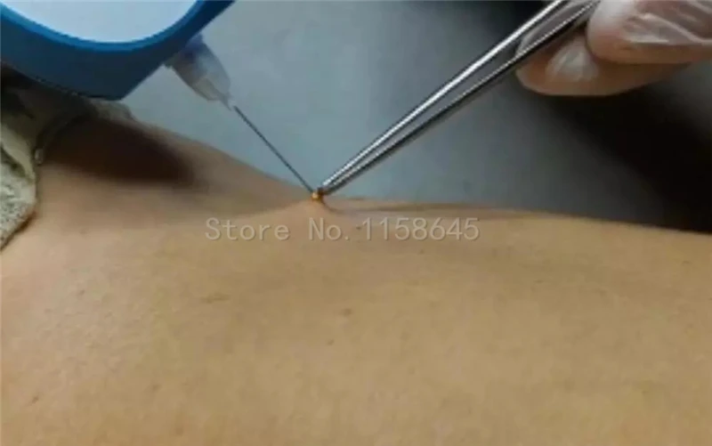 Freckle Spot Removal (9)