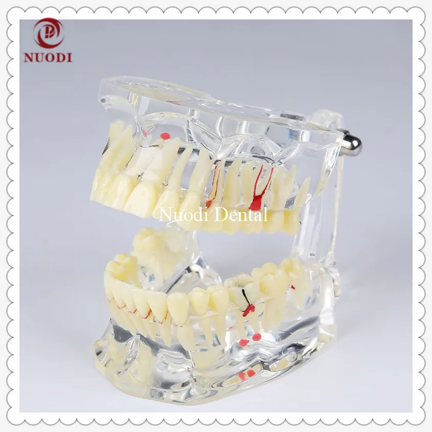 

Dental Implant Bridge Model/Removable implant crown &abutment/Transparent Adult Pathological Teeth Model/Implant teeth model