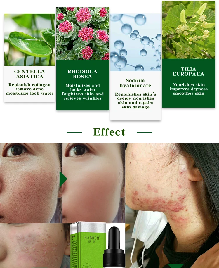 10 mluligopeptide акне очищающий лосьон Сыворотка для лечения акне крем пор восстановление и Отбеливание анти огонек Winkles эссенция увлажняющий