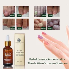 Лечение ногтей эссенция грибка удаление онихомикоза лечение ног восстановление эссенция жидкость@ ME88