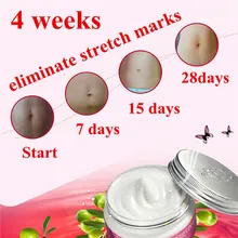 100g AFY Pregnancy Repairing Cream,remove stretch marks fat grain striae gravidarum Postpartum Obesity stretch mark repair cream