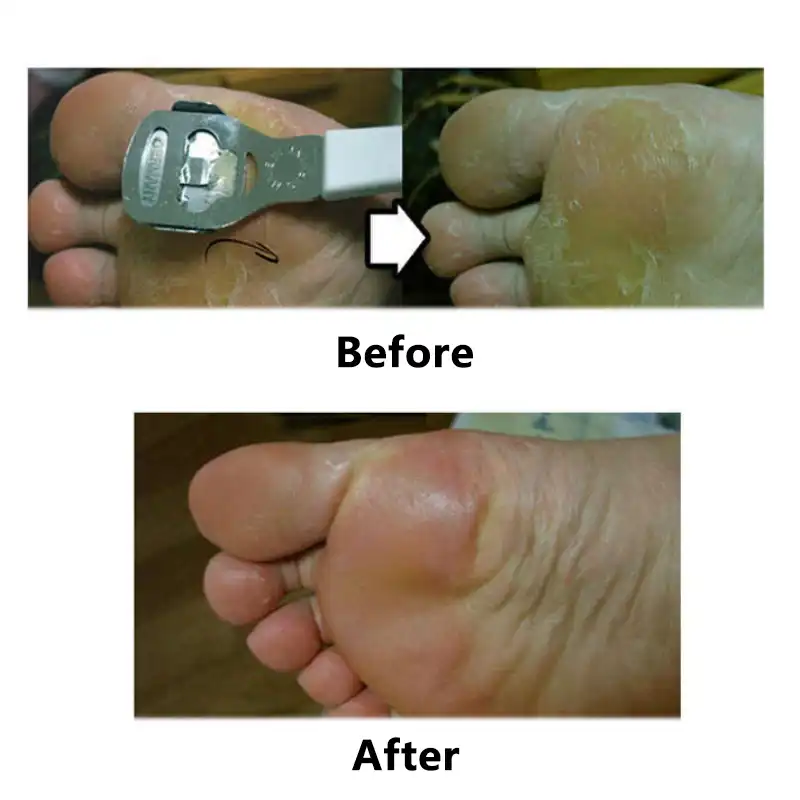 removing hard skin from feet