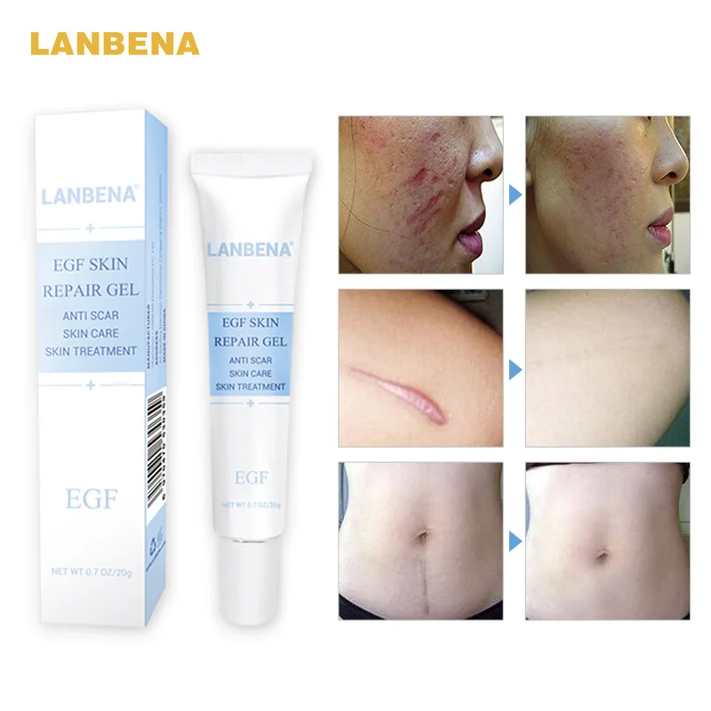 

LANBENA Scar Remover Gel 20g Scars Removal Cream And Stretch Marks Remover Anti-Acne Whitening Cream Acne Treatment Skin Repair