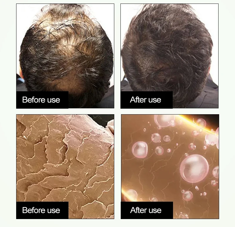 ROSALIND, 20 мл, Кератиновое лечение, сыворотка для волос, маска для лечения волос, кератиновая маска для волос, питающая кожу головы, восстанавливающая, сухая, поврежденная, уход за волосами