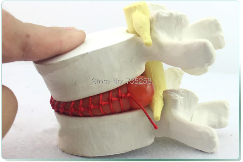 Человеческого поясничного диск демонстрация модели, поясничного диска модель болезни, поясничного отдела позвоночника модель