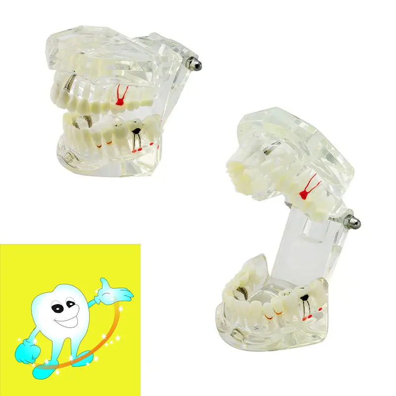 

Dental Demonstrative Implant Disease Teeth Model with Restoration+ Bridge Tooth