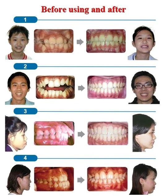 KWOEE выравнивание зубов отбеливание зубов брекеты стоматологическое оборудование Ортодонтические брекеты зубной ортодонтический фиксатор уход за зубами