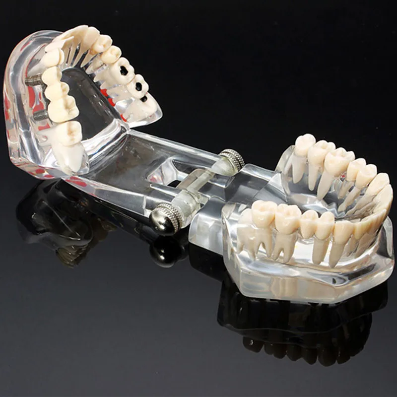 

1Pcs Dental Implant Model With Restoration Bridge Dentist Tools Medical Products Lab Equipment Removable Disease Teeth Model