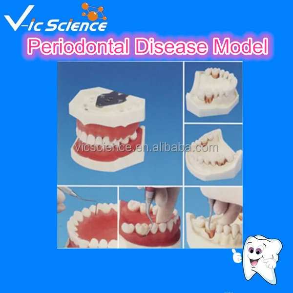 Высокое Качество Пародонтоз Модель