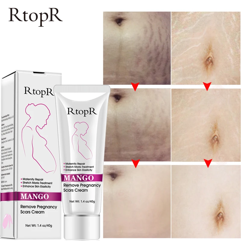 

Mango Pregnancy Scar Remove Acne Cream Eliminate Stretch Marks Treatment Maternity Repair Creams Anti-Aging Anti Winkles Firming