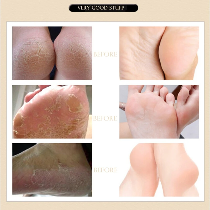 

Natural Herbal Baby Feet Exfoliating Anti-Drying Crack Foot Cream Foot Mask Effective Anti Fungal Dead Skin Feet Care Pro