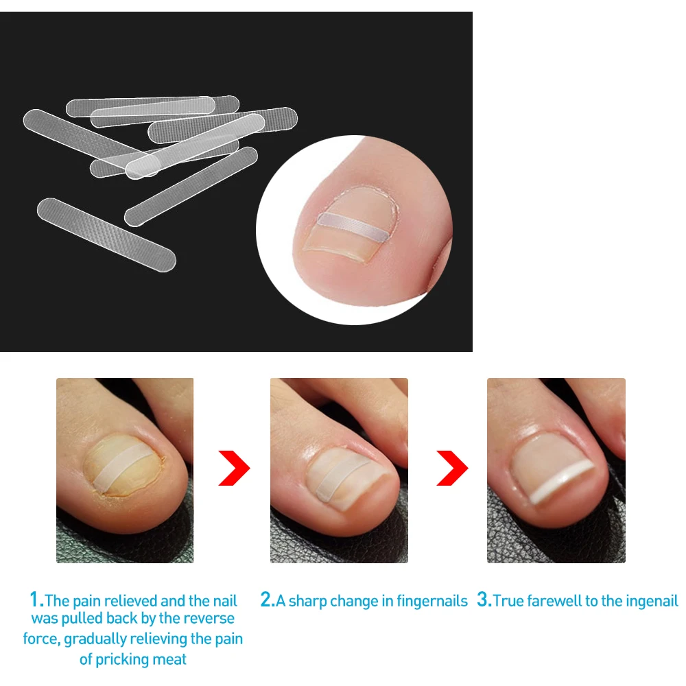 10pcs Toe Nail Ingrown Correction Sticker Patch Foot Care Paronychia Correction File Elastic Patch Corrector Treatment C1510