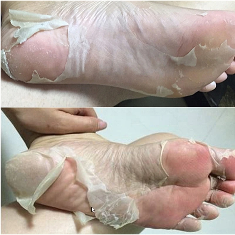 

Dimollaure2Pcs=1Pair Exfoliating Foot Mask for Legs Heels Remove the Skin Foot Patch Cuticles Pedicure Sock Exfoliating Foot Spa