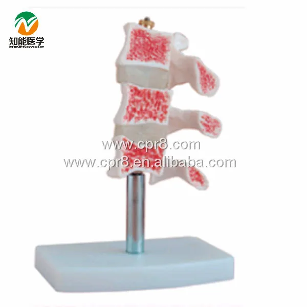 

BIX-A1015 Human Osteoporosis Anatomical Model (3 Vertebrae) WBW344