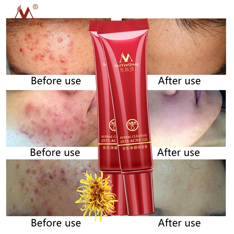 2PCS Skin Care Acne Cleaning Cream Remove Repair Comedone Pimple Acne