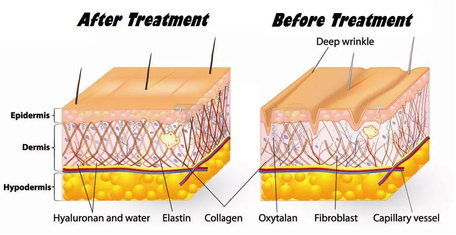 

Glycolic Acid 70% Renewal Peel Exfoliator Pure AHA Cosmetic Strength