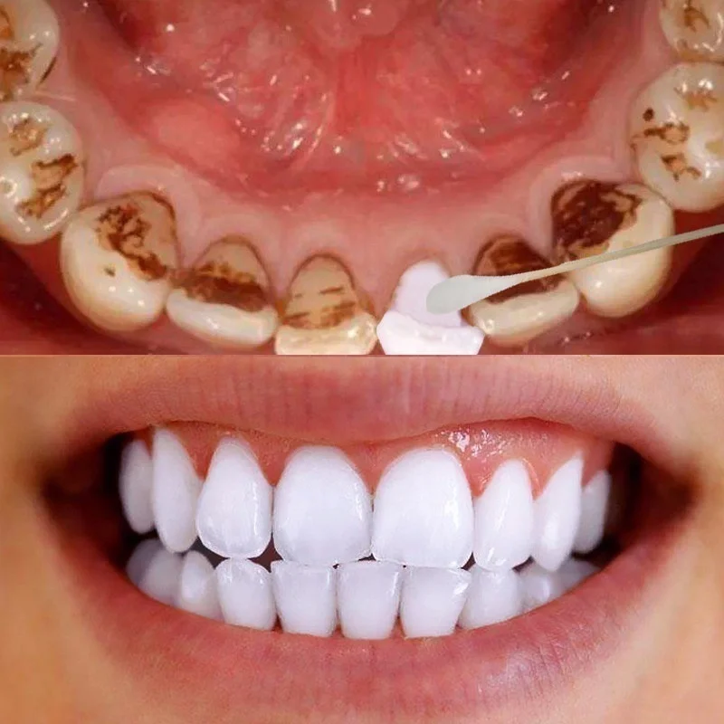 10 мл отбеливание зубов пудра с эссенцией гигиена полости рта Очищающая сыворотка удаляет пятна налета отбеливание зубов стоматологические инструменты зубная паста