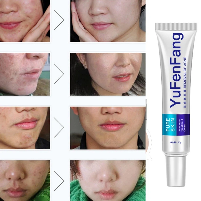 

Useful Anti Acne Cream Pimple Cleaning Moisturizing Oil Control Remove Acne Spots Blemishes Cream