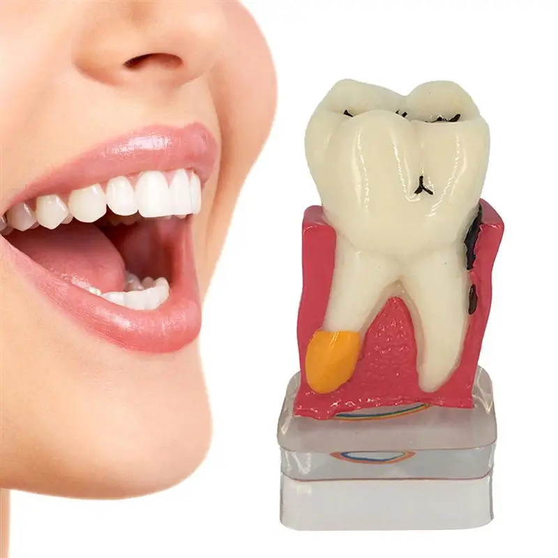 Dental Teeth Model Comprehensive Periodontal Pathological Disease Model