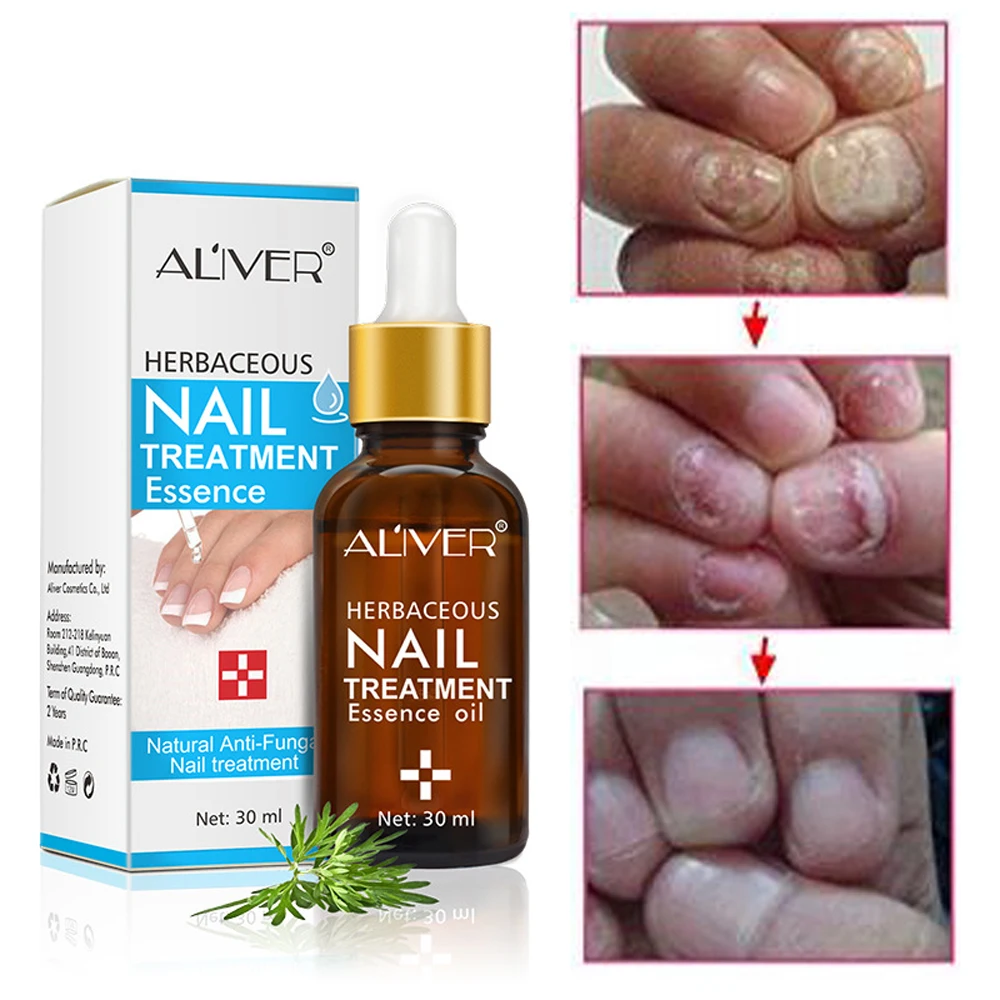 

Fungal Nail Treatment Feet Care Essence Nail Foot Whitening Toe Nail Fungus Removal Gel Anti Infection Paronychia Onychomycosis