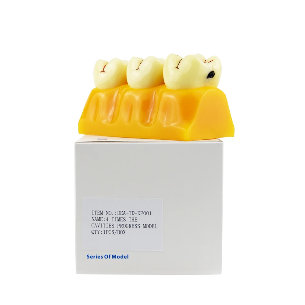 

2018 Sale New 4 Times Cavities Progress Model Two Colors Cavity Preparation For Dental Training Teeth Pathological Anatomical