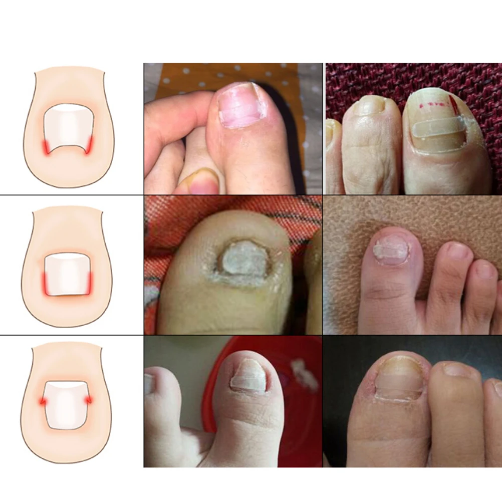 

NEW Ingrown Toe Nail Correction Sticker Patch Paronychia Correction File Foot Care Tool Acronyx Wire Corrector Yellow