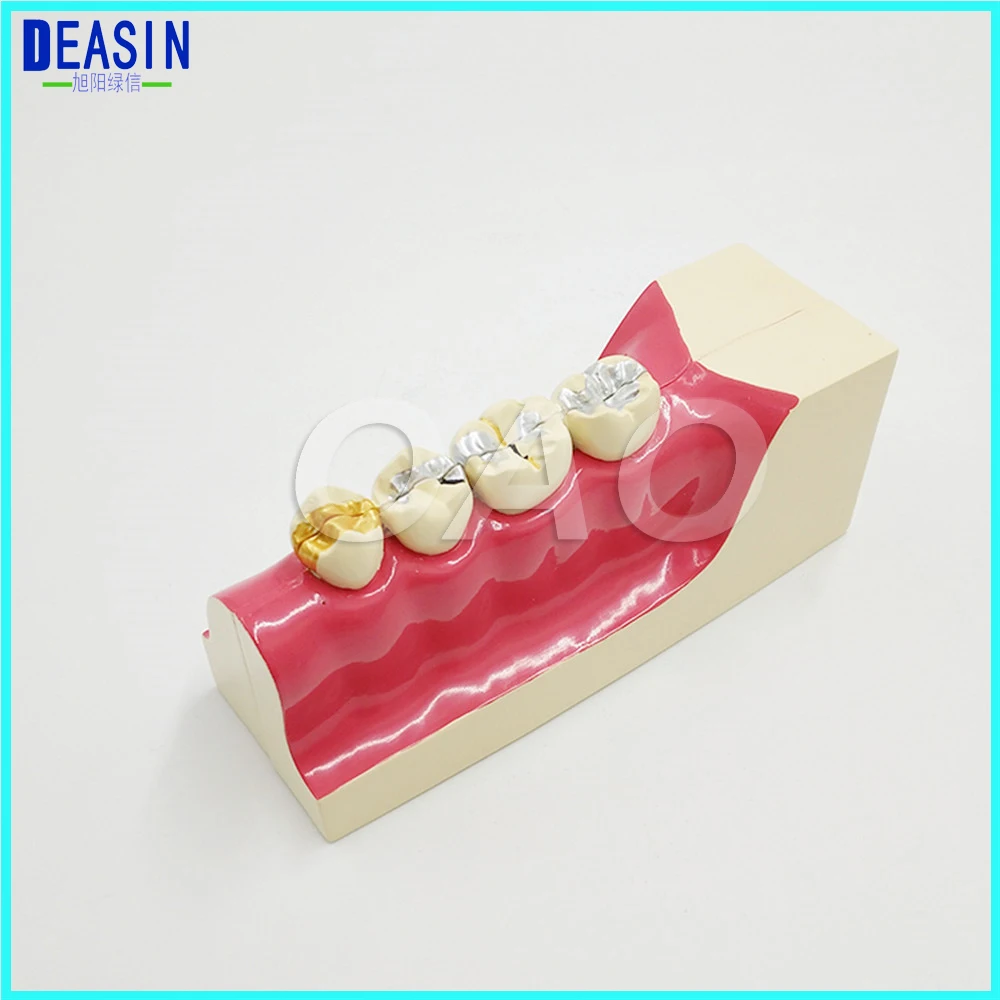 Doctor - patient communication model with magnetic Dental teeth model Lower right posterior teeth tissue decomposition model Doctor - patient communication model with magnetic Dental teeth model Lower right posterior teeth tissue decomposition model