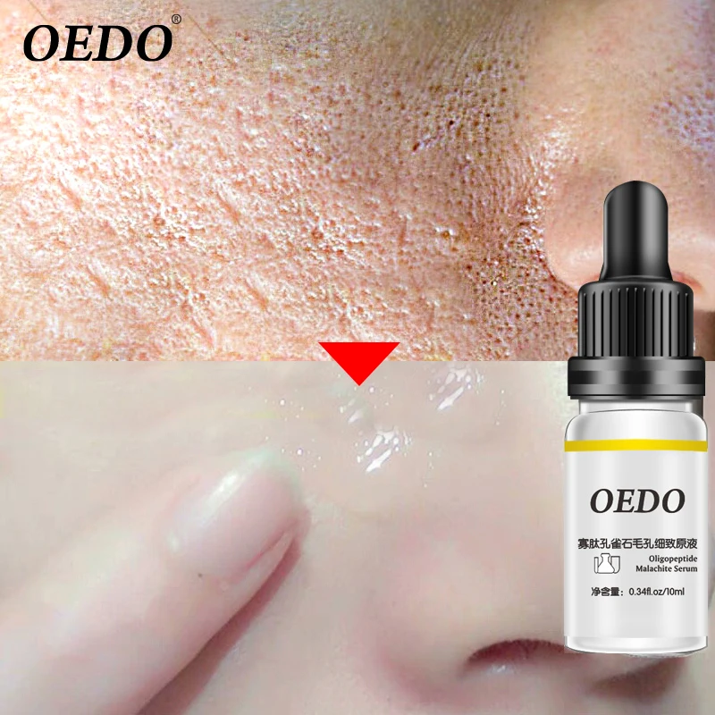 Oedo олигопептидов Малахит Pore Refining влаги увлажненитель с гиалуроновой кислотой устойчивое Отбеливание для очистки пор Уход Сущность купить на AliExpress