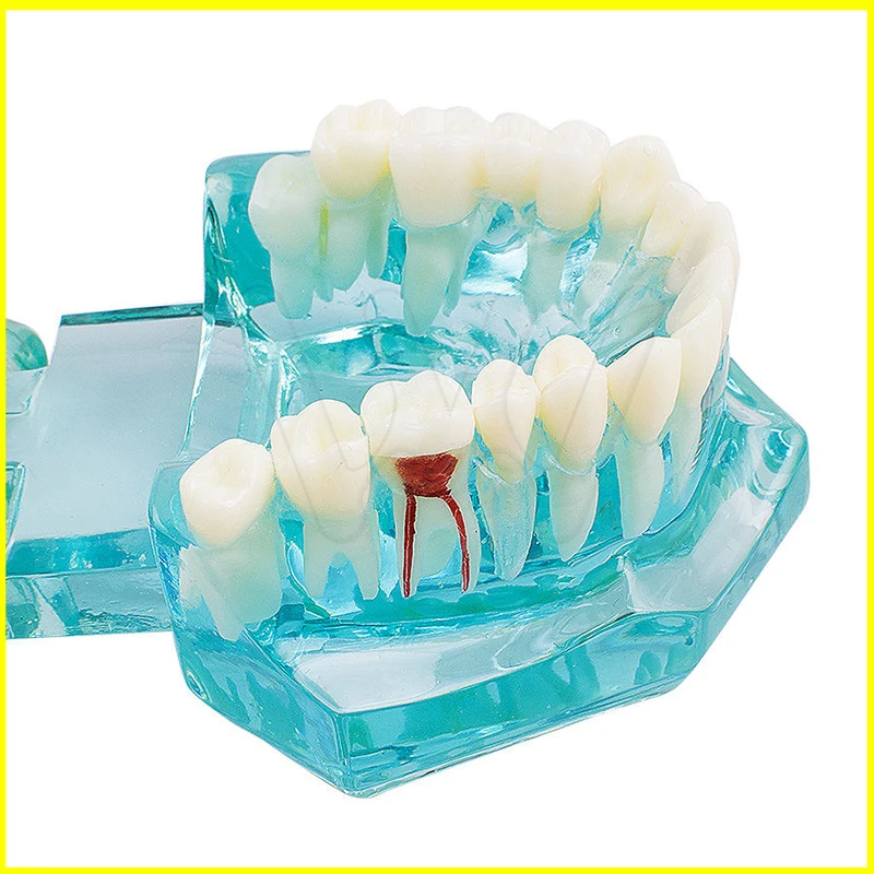 Dental Study Tooth Model Adult Pathological teaching Teeth model new denshine (6)