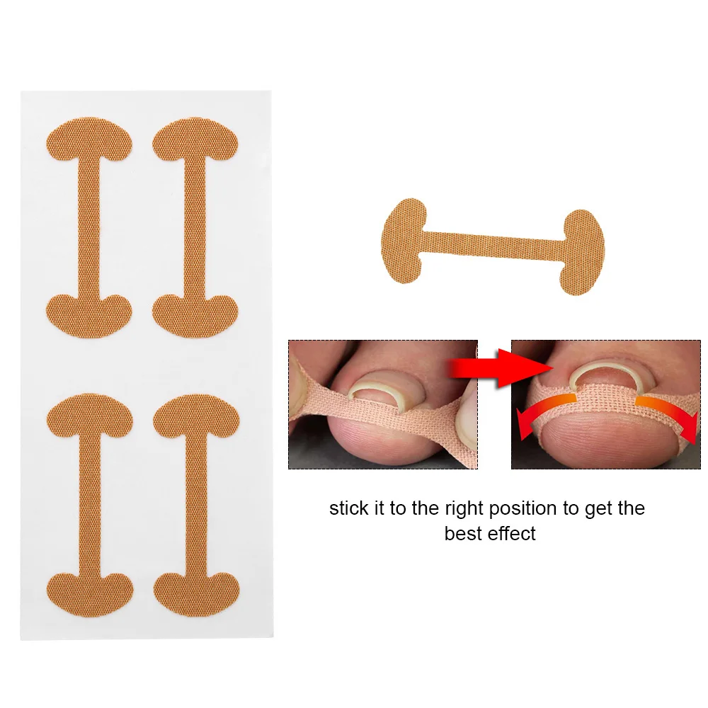Новинка, 4 шт., коррекция вросших пальцев ног, ортодонтический пластырь, фиксатор, педикюр, парониксия, восстановление ногтей, корректор, средство для ухода за ногами
