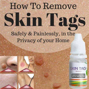 

Skin Tag Remover 12 Hours Tu Medical Tu Kill Remover Skin Tag Mole & Genital Wart Remover Foot Corn Removal