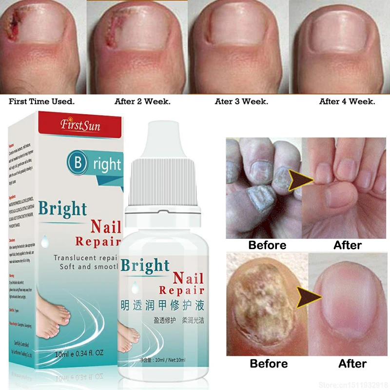 

10ml Nail Fungus Treatment Cream Onychomycosis Paronychia Anti Fungal Nail Infection Kills 99.9% Bacteria and Fungus