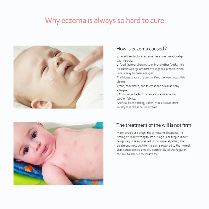 Детский крем мазь Eczema москитные укусы антибактериальные анти-зудящая кожа средства по уходу