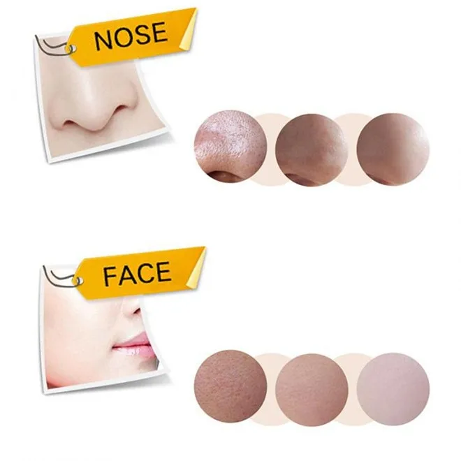 blackhead removal 6