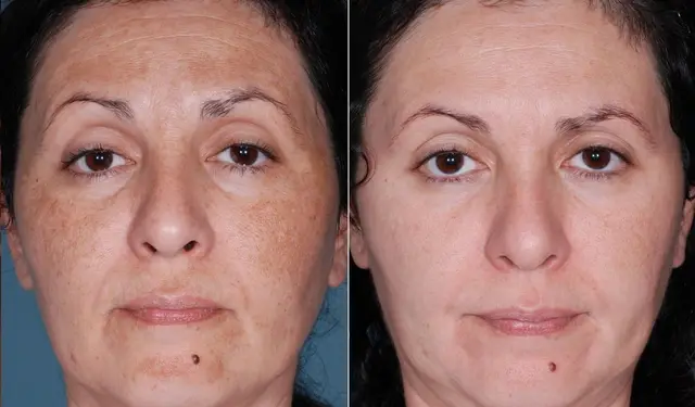 salicylic acid facial peel Salicylic acid facial peel