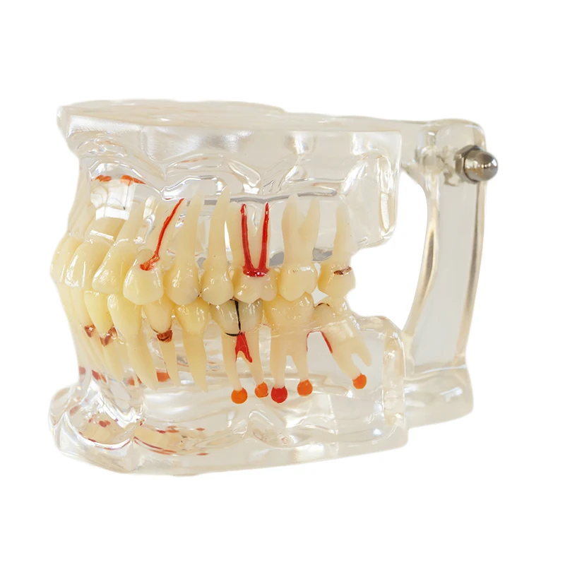 

1PC Dental Model Pathology Model with half implant