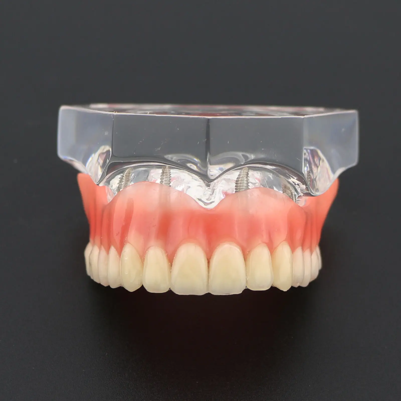Стоматологическая модель верхних зубов Overdenture Superior 4 имплантата 6001