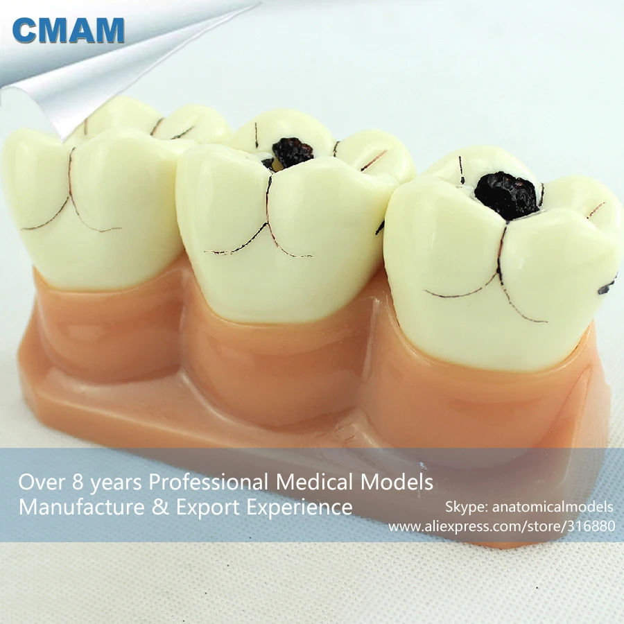 

12575 / Human Tooth Anatomy Dental Caries Model in 7 Parts, Medical Science Educational Teaching Anatomical Models