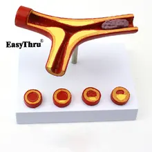 Arteriosclerosis Model (with Thrombus) Thrombosis Model Cardiology Doctors and Patients Communication Physician Teaching Model цена Arteriosclerosis Model (with Thrombus) Thrombosis Model Cardiology Doctors and Patients Communication Physician Teaching Model цены онлайн