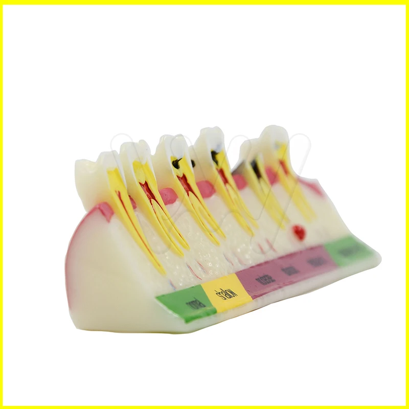 Dental-Caries-Developing-illusteation-Tooth-Model-Demonstration-Teach-_57 (2)