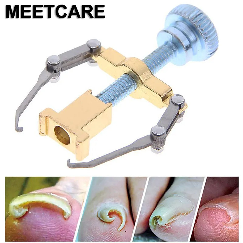 

Pedicure Nail Corrector Podiatrist Manicure Tools to Cure Curl Embedded Toenails Caused by Paronychia or Onychomycosis