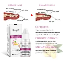 RtopR имбирь антибактериальное лечение ногтей onychomicosis Paronychia против грибковых ногтей инфекция пальцев ног Лечение грибка 10 мл