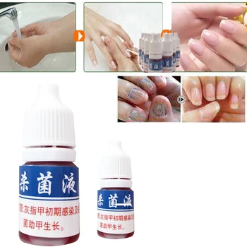 

Chinese Medicine Nail Fungus Treatment Anti Fungal Nail Solution Ringworm Clear Healthy Toenail Growth Massage D241